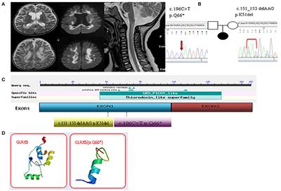 Case Report: A Variant Non-ketotic Hyperglycinemia With GLRX5 Mutations: Manifestation of Deficiency of Activities of the Respiratory Chain Enzymes